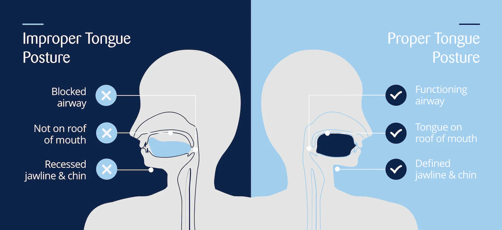 Diagram comparing improper tongue posture (tongue low, blocked airway, recessed jawline) with proper tongue posture (tongue on roof of mouth, functioning airway, defined jawline)